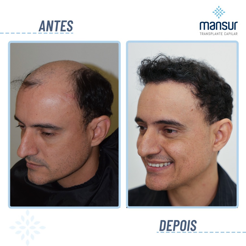 Resultado FUE+FUT — 13.800 folículos