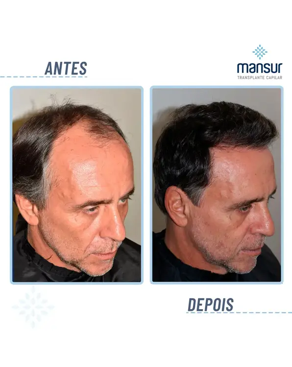 Resultado FUE — 7.000 folículos