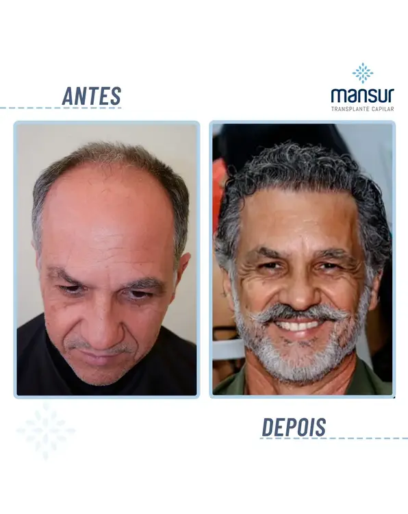 Resultado FUE — 9.420 folículos