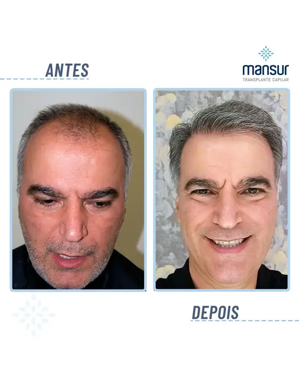 Resultado FUE — 8.580 folículos