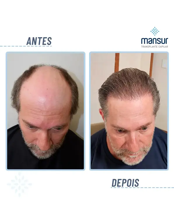 Resultado FUE+FUT — 9.800 folículos