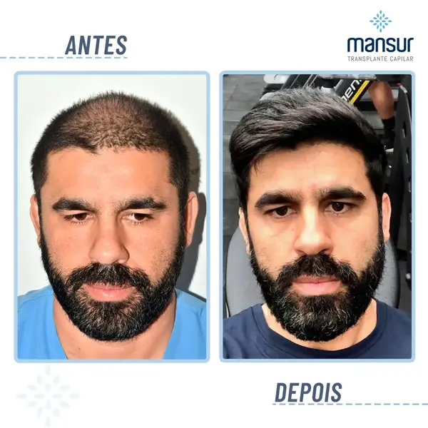 Resultado FUE+FUT — 9.920 folículos