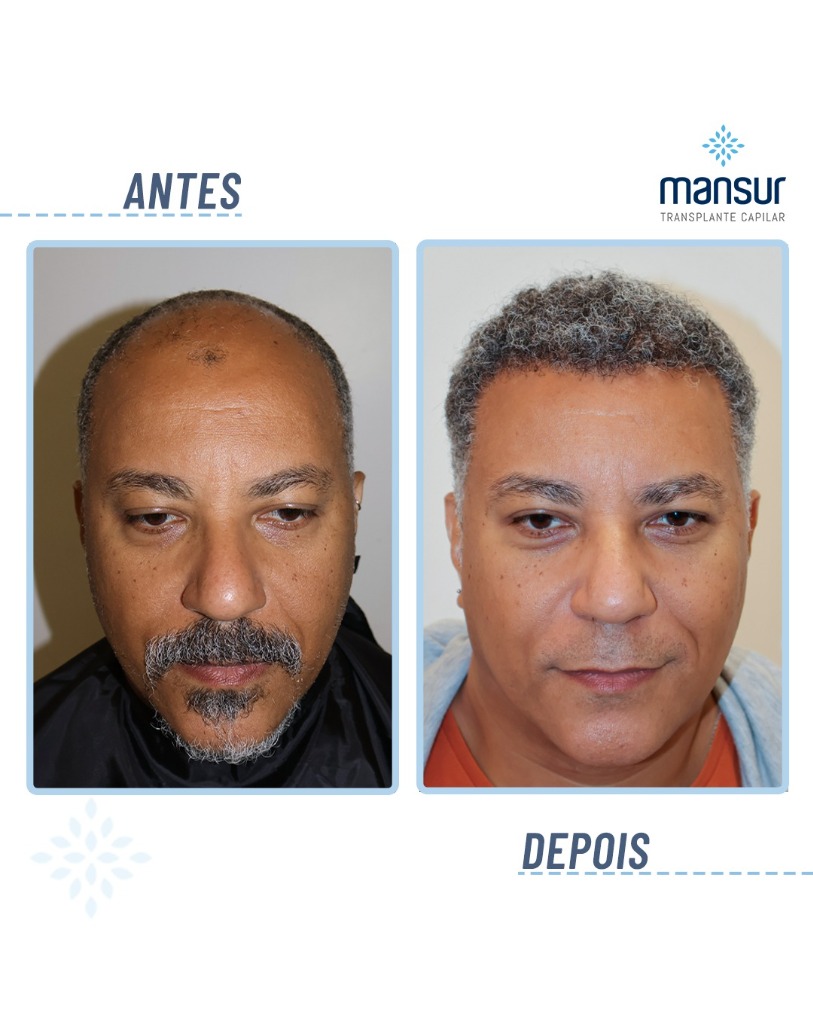 Resultado FUE — 5.840 folículos